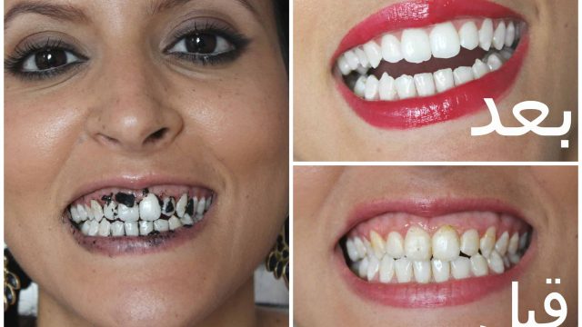جربي أفضل الخلطات الطبيعية لتبييض الأسنان