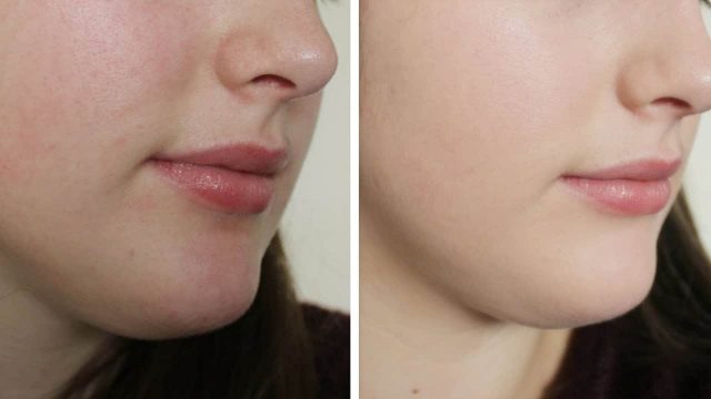 تخلصي من بقع حروق الشمس بهذه المكونات الطبيعية