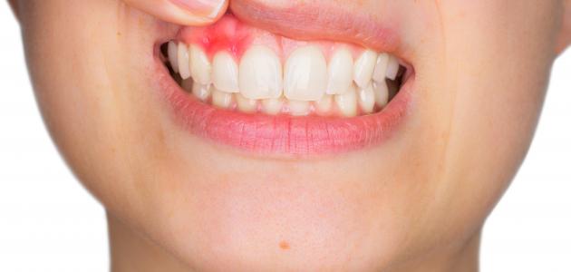 وصفات طبيعية لعلاج نزيف والتهابات اللثة