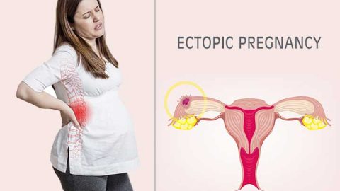 الحمل خارج الرحم: العلامات وطرق العلاج