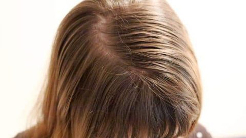 وصفات طبيعية لعلاج القشرة للشعر الدهني