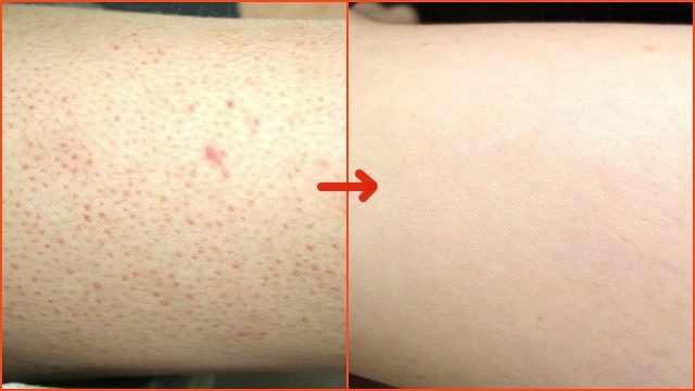 إليك طرق التخلص من الشعر تحت الجلد