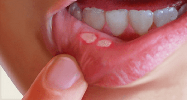 وصفات طبيعية لعلاج تقرحات الفم