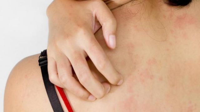 علاج حساسية الجلد بالأعشاب الطبيعية نهائيا