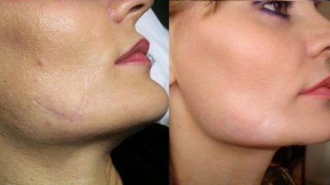 علاجات منزلية ضد الندوب لا تفوتيها