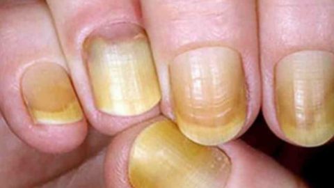 أظافرك تخبرك بمشاكلك الصحية
