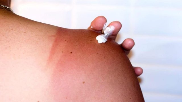 كيف تعالجين حروق الشمس في خطوات بسيطة؟