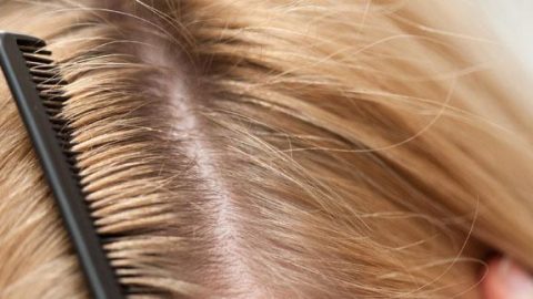 الأسبرين للتخلص من قشرة الشعر