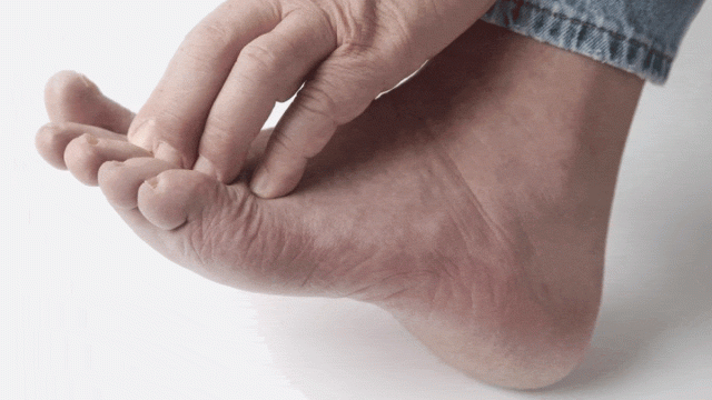 تخلصي من فطريات القدمين بهذه العلاجات المنزلية