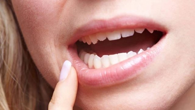 تعرفي على مرض تراجع اللثة وطريقة علاجه