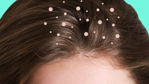 وصفات طبيعية لعلاجات قشرة الشعر
