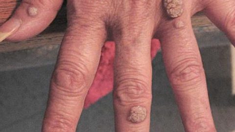 إليك أفضل العلاجات المنزلية للتخلص من الثالول