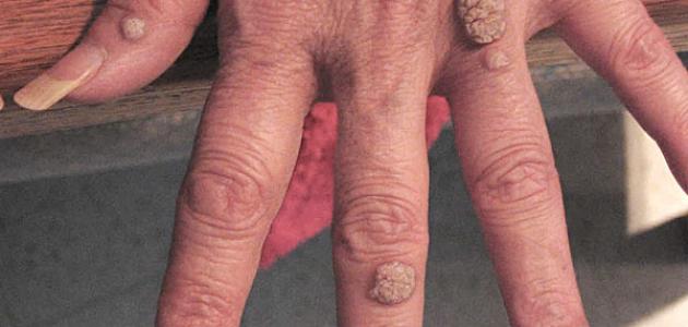 إليك أفضل العلاجات المنزلية للتخلص من الثالول