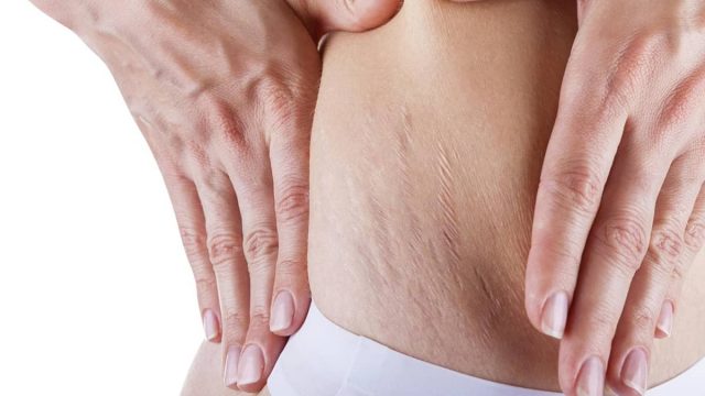 علاجات طبيعية للتخفيف من علامات التمدد