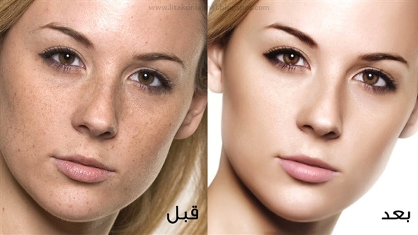 علاجات طبيعية للتخلص من كلف الحمل