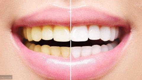5 مكونات طبيعية فعالة لتبييض الأسنان