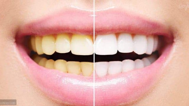 5 مكونات طبيعية فعالة لتبييض الأسنان