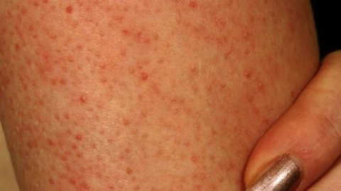 تعرفي على أفضل العلاجات الطبيعية للتقرن الشعري