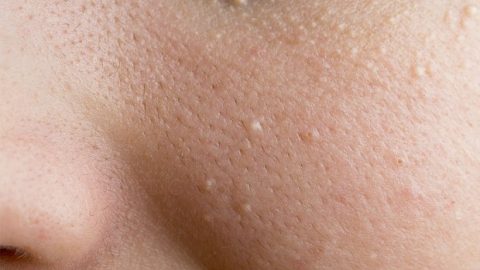 علاجات طبيعية للتخلص من الحبوب البيضاء تحت العينين