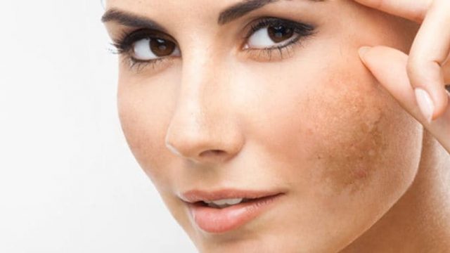 تخلصي من الكلف والنمش بأفضل العلاجات المنزلية