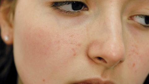 تخلصي من حبوب البشرة الدهنية بهذا المزيج السحري