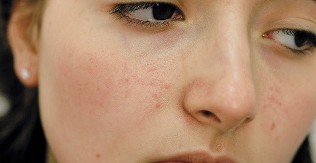 تخلصي من حبوب البشرة الدهنية بهذا المزيج السحري