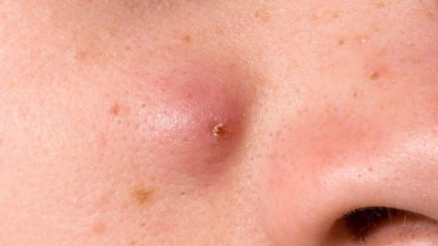 عالجي الحبوب تحت الجلد حسب أماكن ظهورها