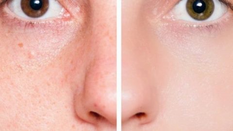 علاجات طبيعية للحد من مشكلة المسام الواسعة