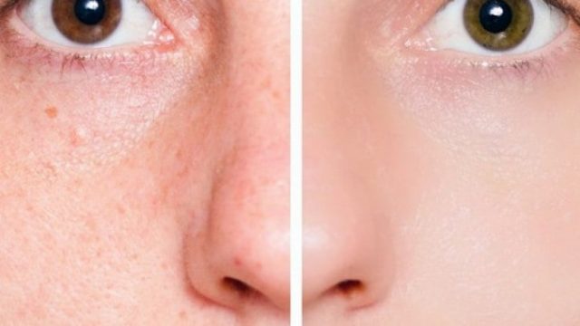 علاجات طبيعية للحد من مشكلة المسام الواسعة