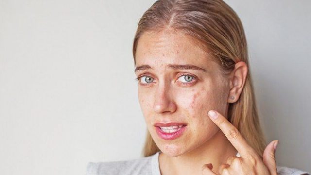 عالجي ندوب حب الشباب بهذه المكونات البسيطة