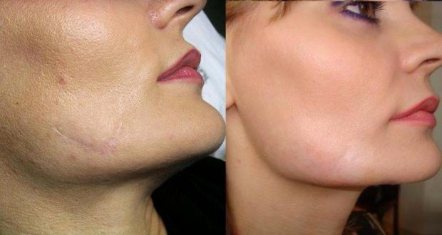 وصفات طبيعية لتخفيف الندوب وآثار حب الشباب