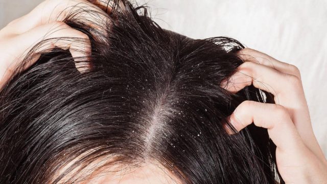 5 نصائح تقيك من مشكلات القشرة المزعجة… اكتشفيها الآن