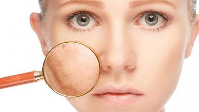 ماسكات طبيعية لإزالة الكلف نهائيًا في 7 أيام