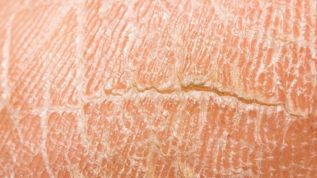 تخلصي من التشققات المزعجة بحسب أماكن ظهورها في الجسم