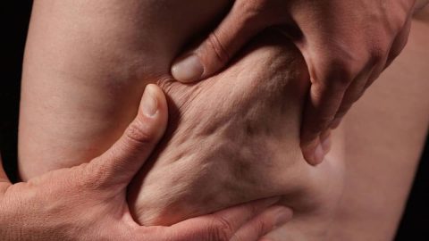 علاجات غير مكلفة تخلصك من السيلوليت.. جربيها