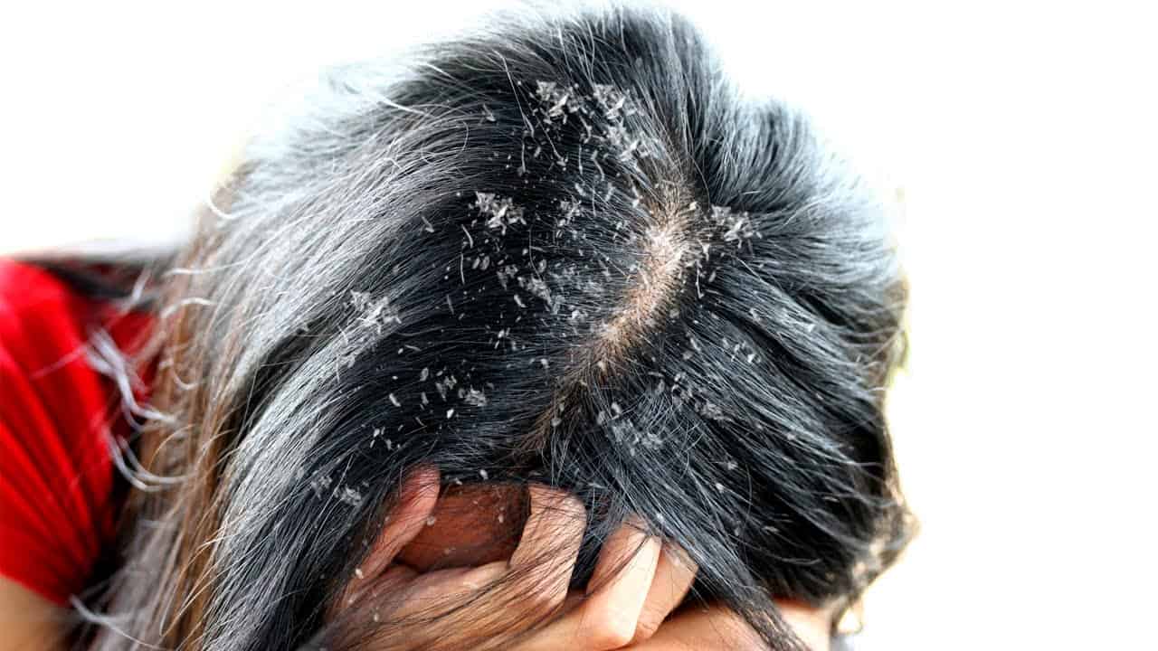 عالجي مشكلة فروة الرأس الجافة بمكون واحد فقط من مطبخك مجلة سيدات الامارات