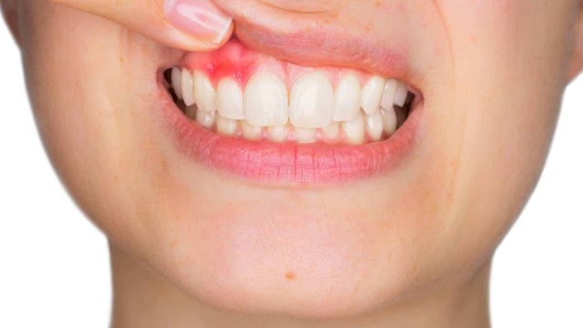كيفية علاج التهاب اللثة في المنزل