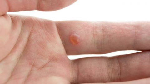 علاجات منزلية للتخلص من الثالول نهائيا