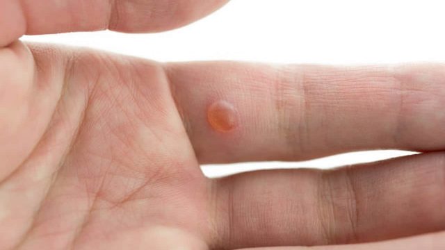 علاجات منزلية للتخلص من الثالول نهائيا