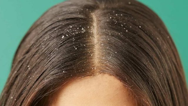 تخلصي من مشكلة القشرة نهائيًا بهذا الغسول الطبيعي