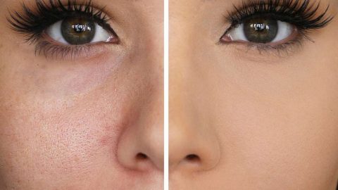 3 علاجات منزلية لتضييق المسام الواسعة