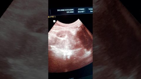 الحمل مع اللولب هل هو ممكن؟