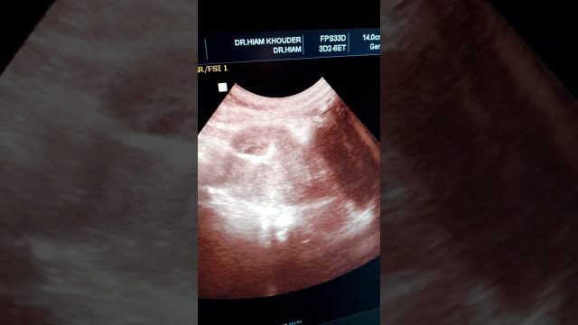 الحمل مع اللولب هل هو ممكن؟