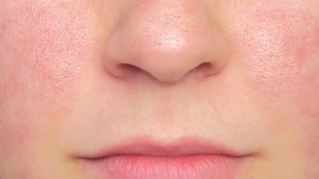 خلطات لعلاج المسامات الواسعة في الوجه