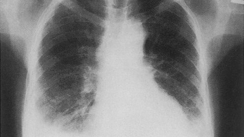 ما هي أسباب المياه في الرئة وطرق علاجها