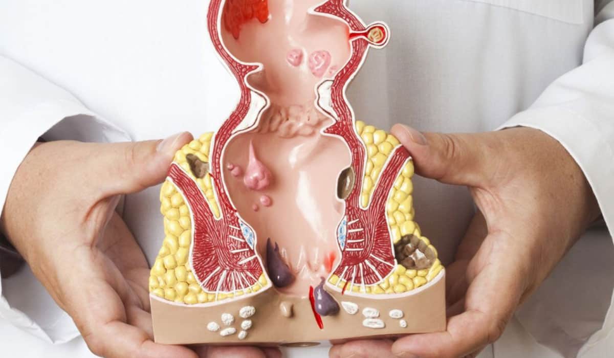 علاج البواسير