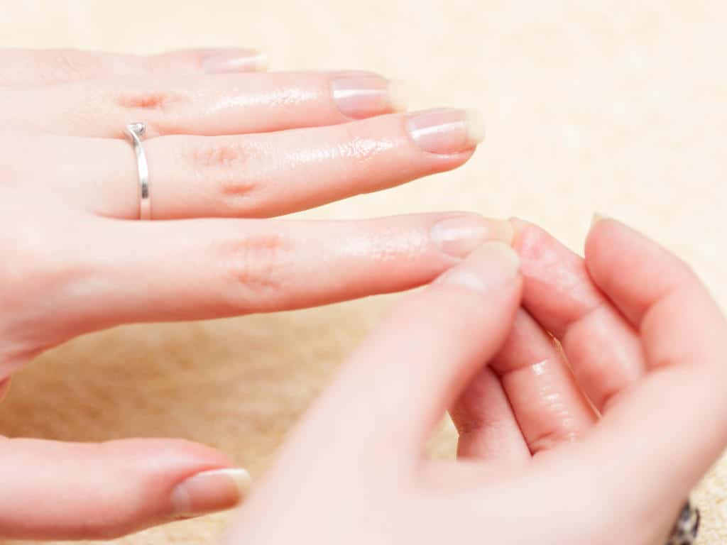 أعراض نقص الكالسيوم