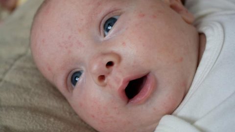 ماهي أسباب ظهور الحبوب على وجه الرضع؟