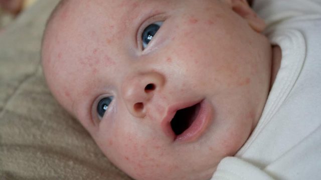 ماهي أسباب ظهور الحبوب على وجه الرضع؟