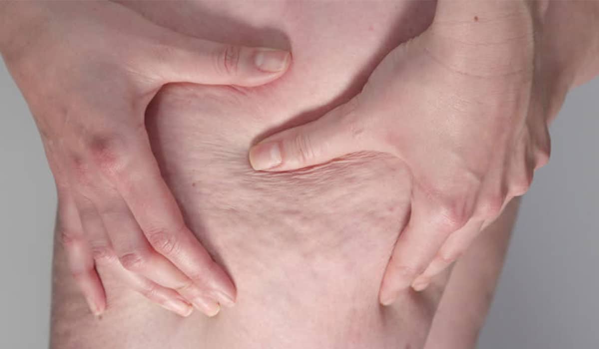 ترهل البشرة بعد التخسيس